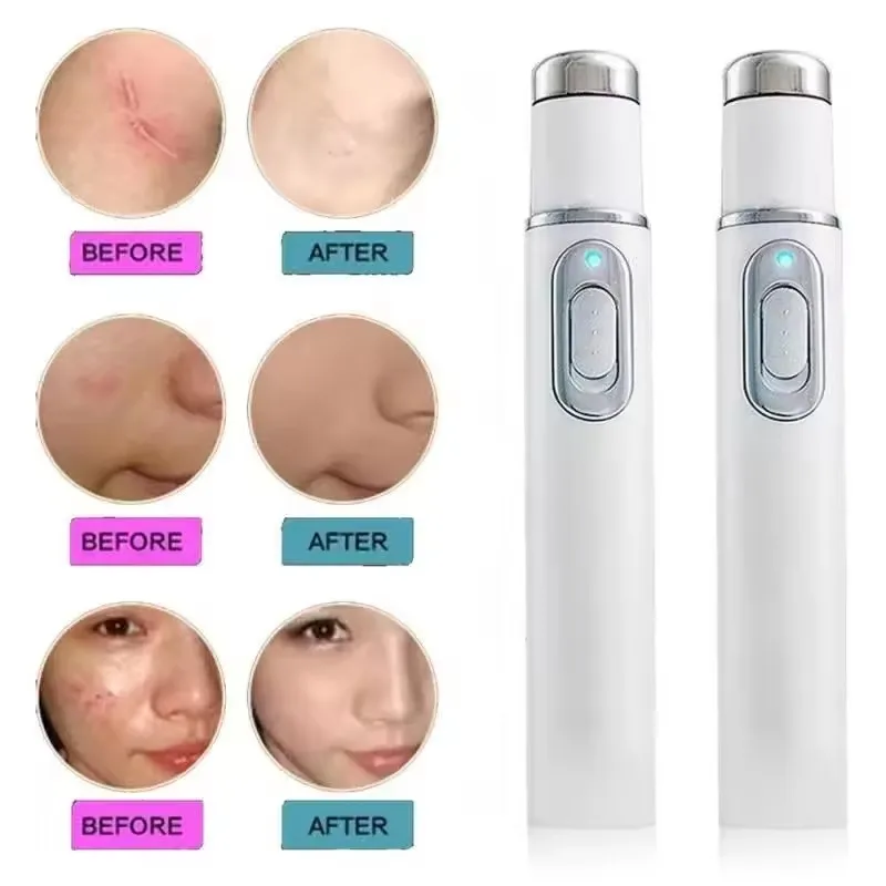 ปากกาบำบัดด้วยแสงสีฟ้าสำหรับรั - Acne Light Therapy Pen บทวิจารณ์และราคา