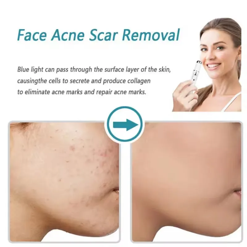 ปากกาบำบัดด้วยแสงสีฟ้าสำหรับรั - Acne Light Therapy Pen บทวิจารณ์และราคา